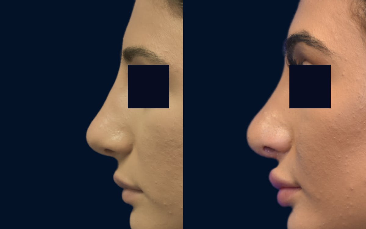 Rhinoplasty Before & After Gallery - Patient 386564 - Image 1