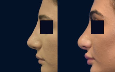 Rhinoplasty Before & After Gallery - Patient 386564 - Image 1