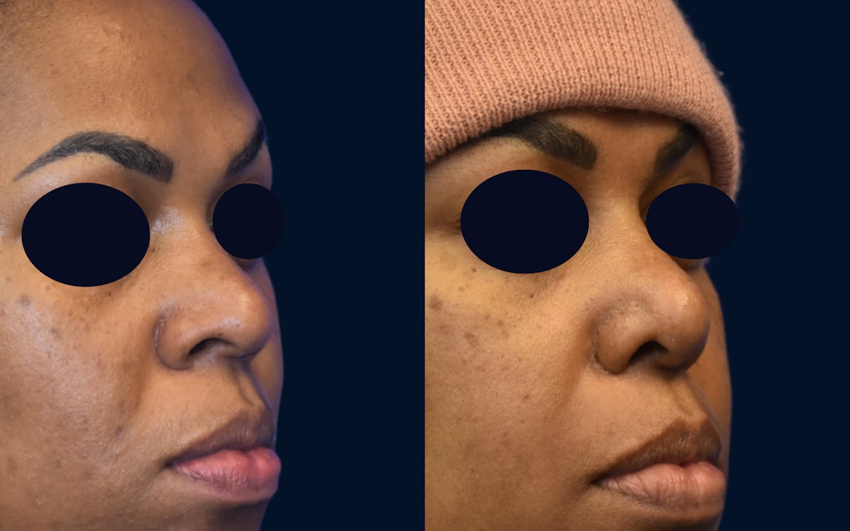 Rhinoplasty Before & After Gallery - Patient 313483 - Image 2