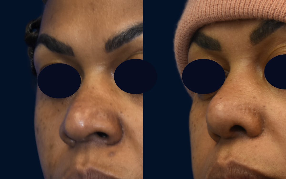 Rhinoplasty Before & After Gallery - Patient 313483 - Image 3