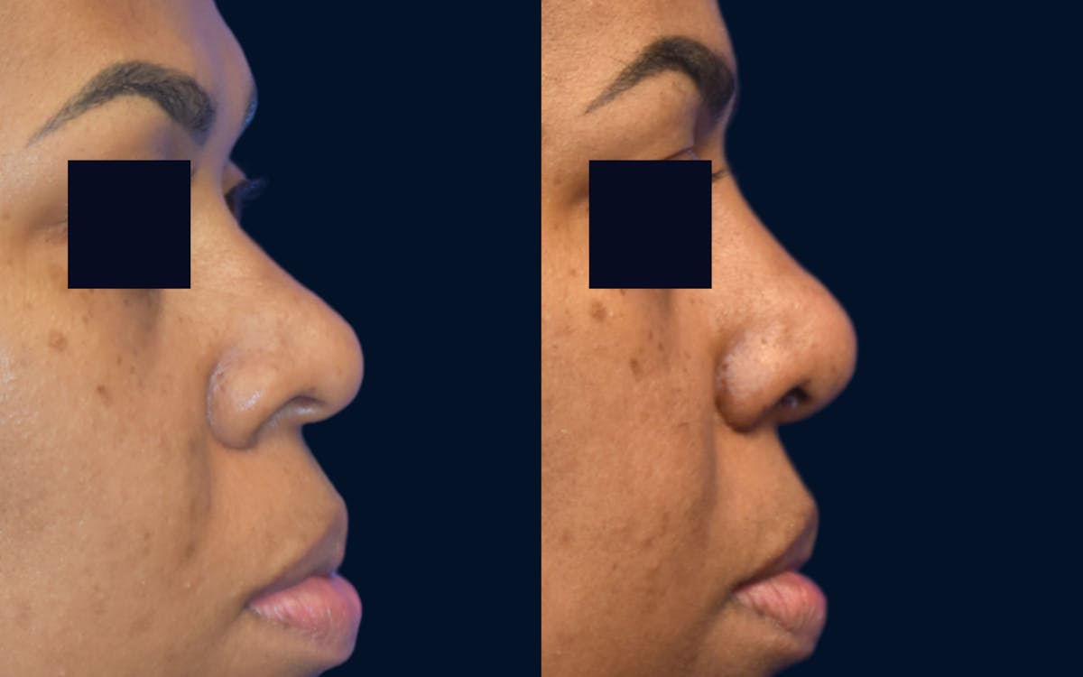 Rhinoplasty Before & After Gallery - Patient 313483 - Image 1