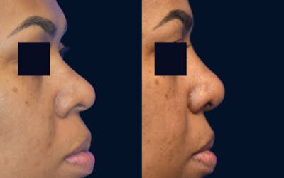 Rhinoplasty Before & After Gallery - Patient 313483 - Image 1