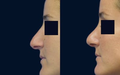 Rhinoplasty Before & After Gallery - Patient 266092 - Image 1