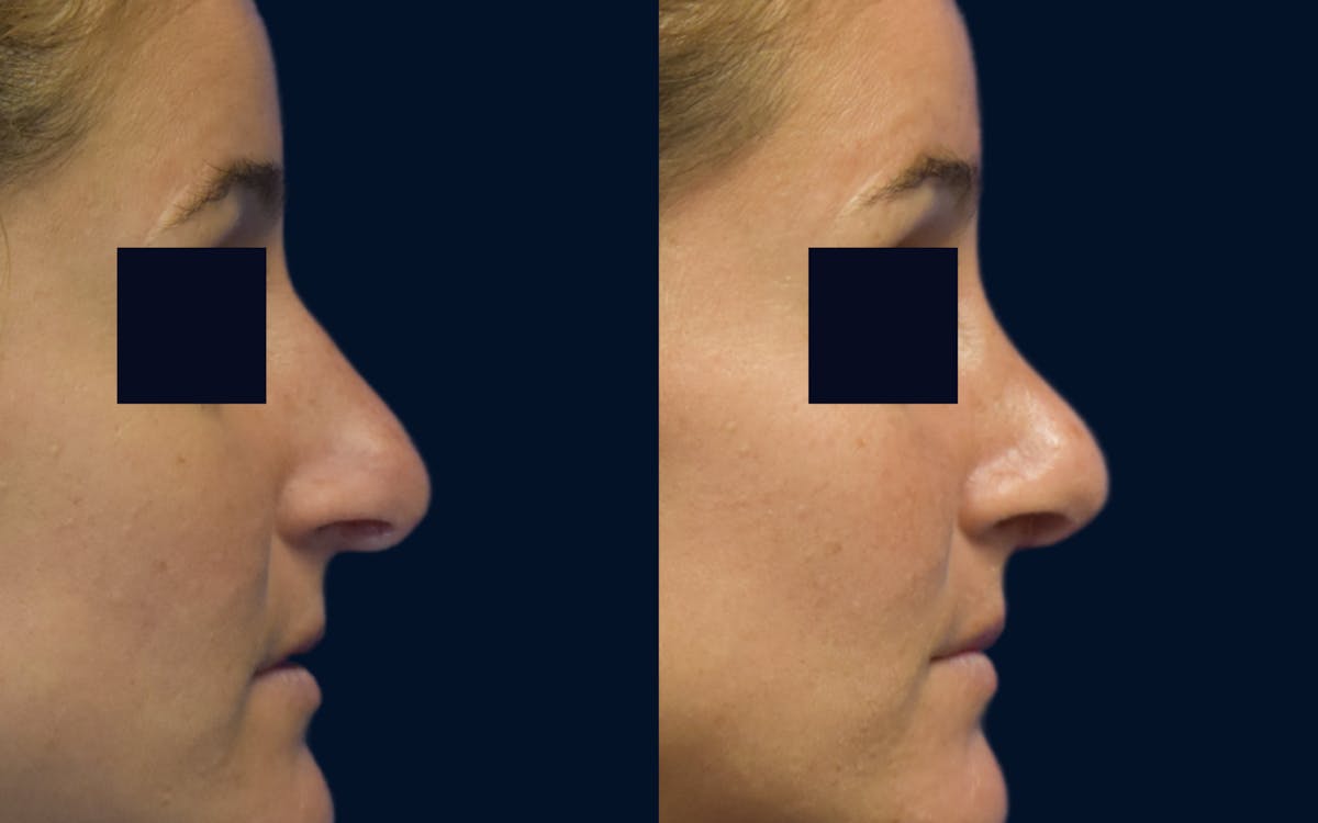 Rhinoplasty Before & After Gallery - Patient 266092 - Image 2
