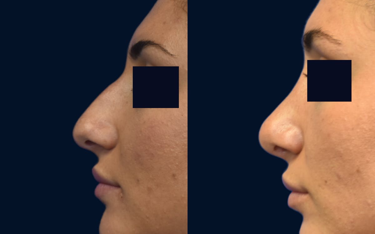 Rhinoplasty Before & After Gallery - Patient 366521 - Image 1