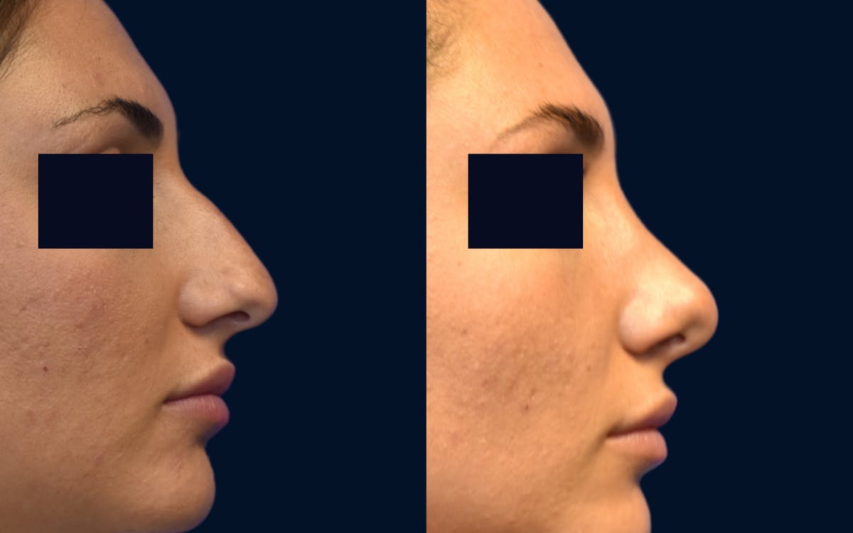 Rhinoplasty Before & After Gallery - Patient 366521 - Image 2