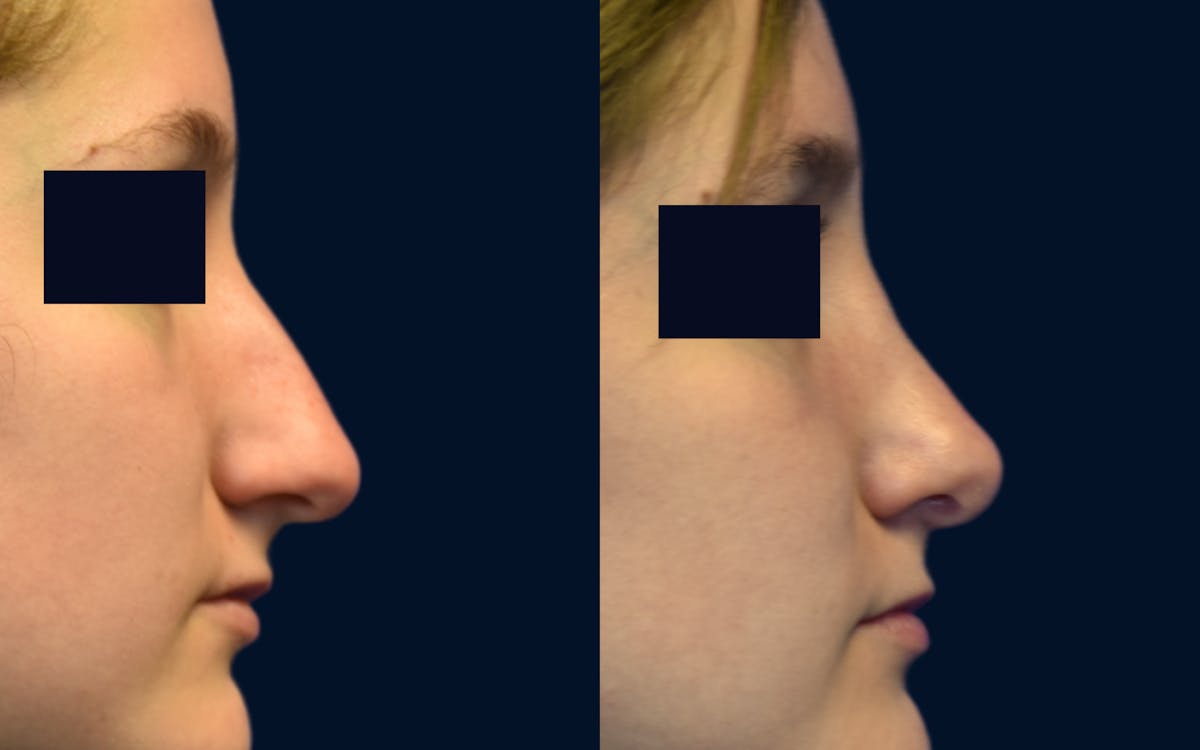 Rhinoplasty Before & After Gallery - Patient 315194 - Image 2