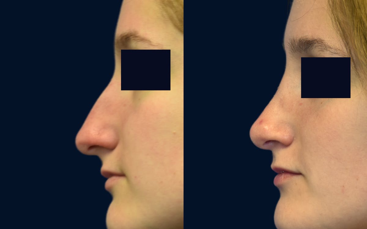 Rhinoplasty Before & After Gallery - Patient 315194 - Image 1