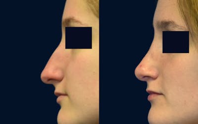 Rhinoplasty Before & After Gallery - Patient 315194 - Image 1