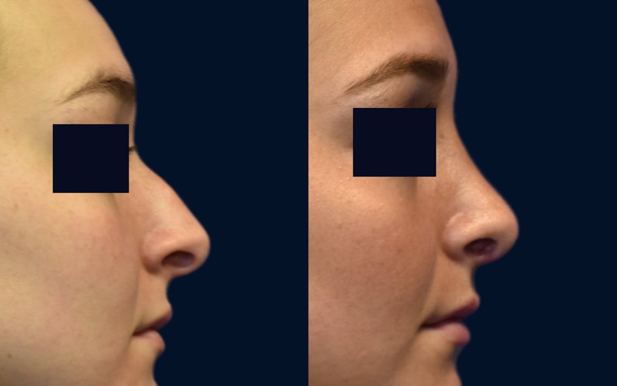 Rhinoplasty Before & After Gallery - Patient 404268 - Image 2