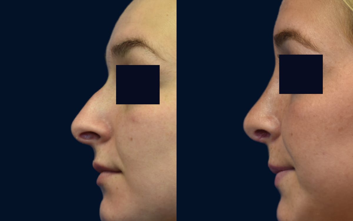 Rhinoplasty Before & After Gallery - Patient 404268 - Image 1