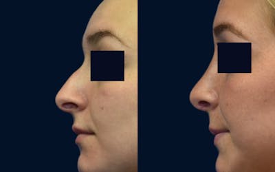 Rhinoplasty Before & After Gallery - Patient 404268 - Image 1