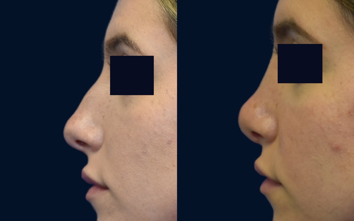 Rhinoplasty Before & After Gallery - Patient 245655 - Image 1