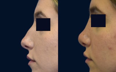 Rhinoplasty Before & After Gallery - Patient 245655 - Image 1