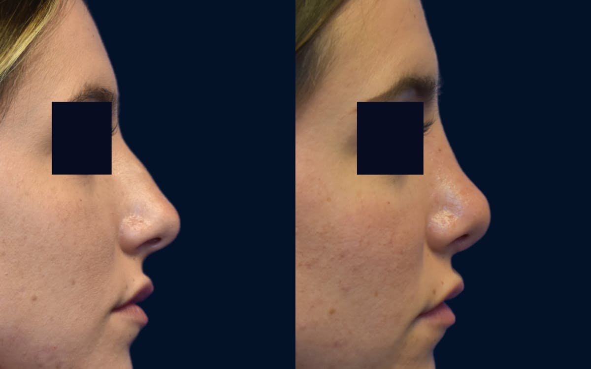 Rhinoplasty Before & After Gallery - Patient 245655 - Image 2