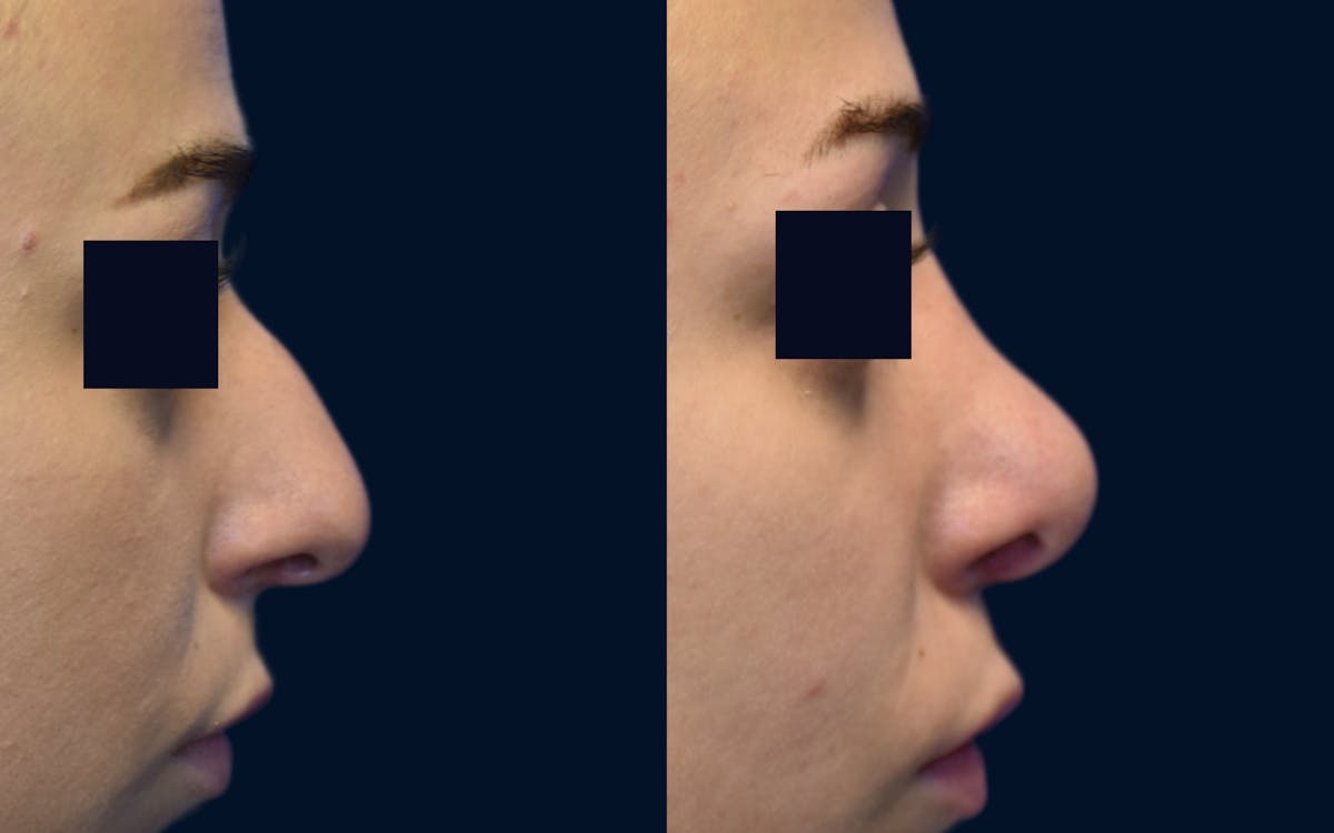 Rhinoplasty Before & After Gallery - Patient 534816 - Image 2