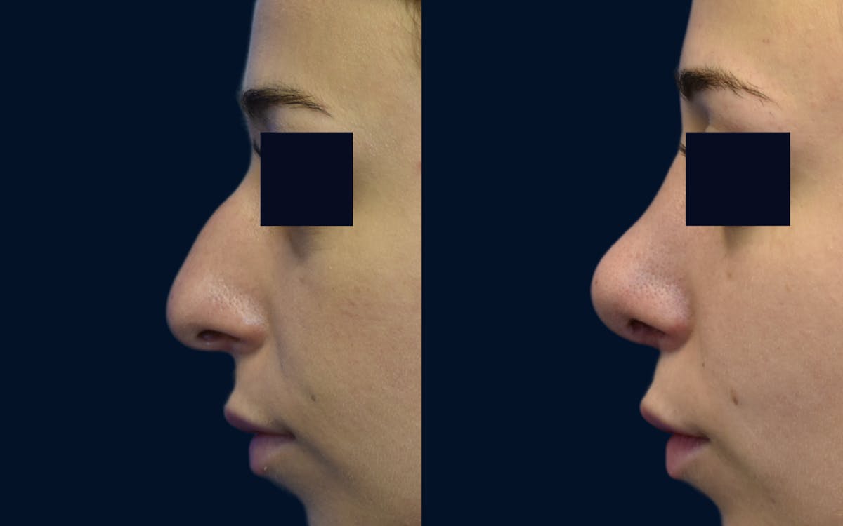 Rhinoplasty Before & After Gallery - Patient 534816 - Image 1