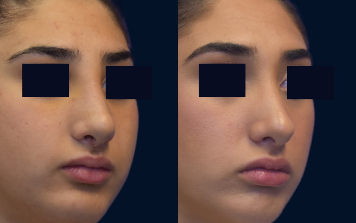 Rhinoplasty Before & After Gallery - Patient 384741 - Image 2