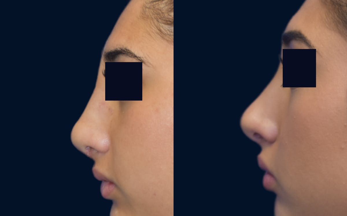 Rhinoplasty Before & After Gallery - Patient 384741 - Image 1
