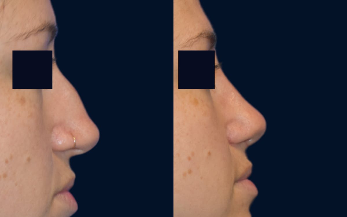 Rhinoplasty Before & After Gallery - Patient 182326 - Image 2