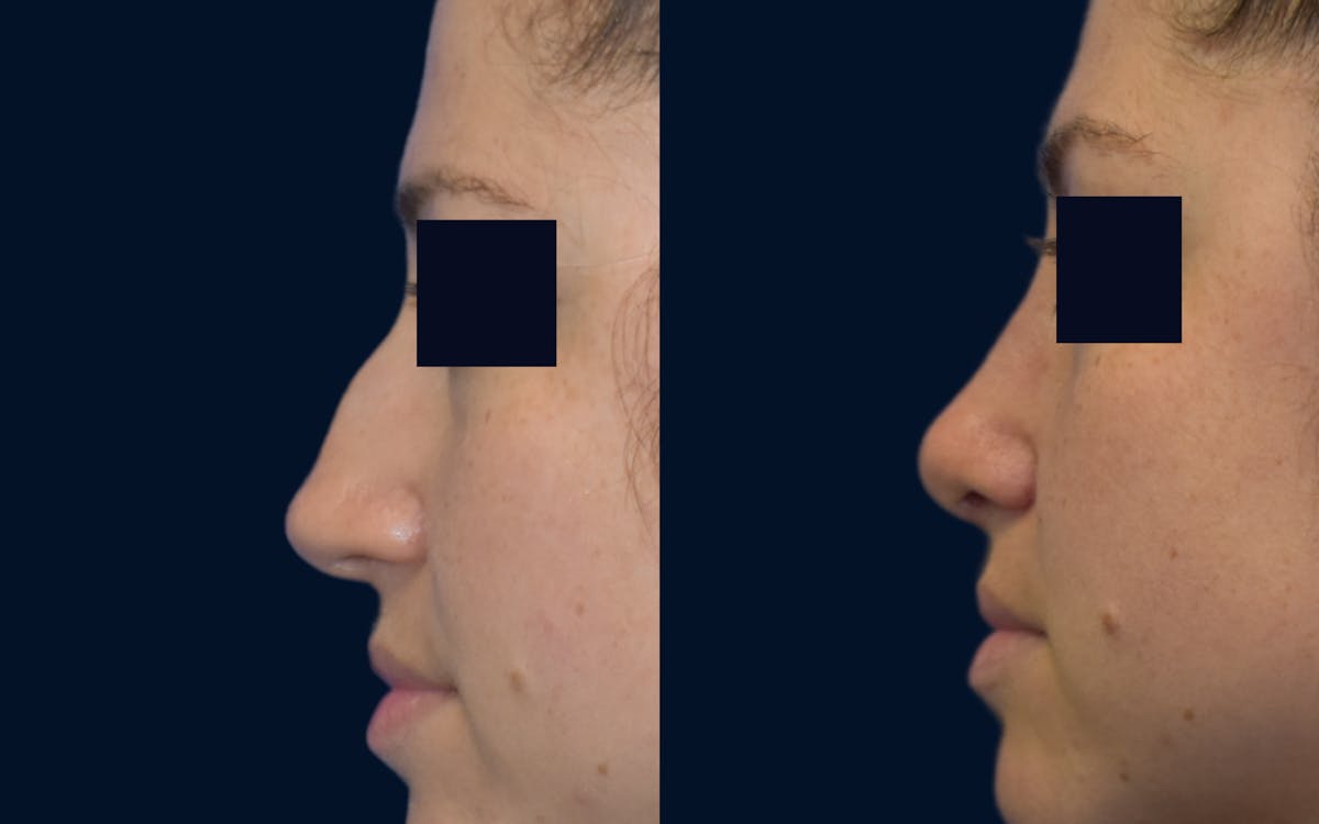 Rhinoplasty Before & After Gallery - Patient 182326 - Image 1