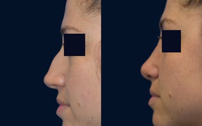 Rhinoplasty Before & After Gallery - Patient 182326 - Image 1