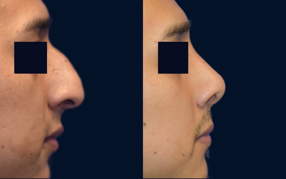 Rhinoplasty Before & After Gallery - Patient 242021 - Image 2