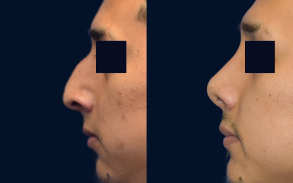 Rhinoplasty Before & After Gallery - Patient 242021 - Image 1