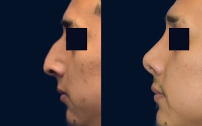 Rhinoplasty Before & After Gallery - Patient 242021 - Image 1