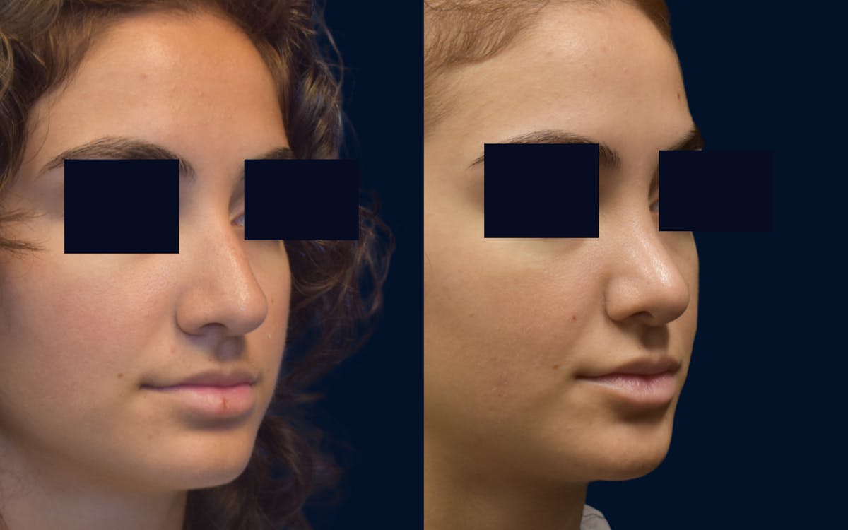 Rhinoplasty Before & After Gallery - Patient 193047 - Image 2