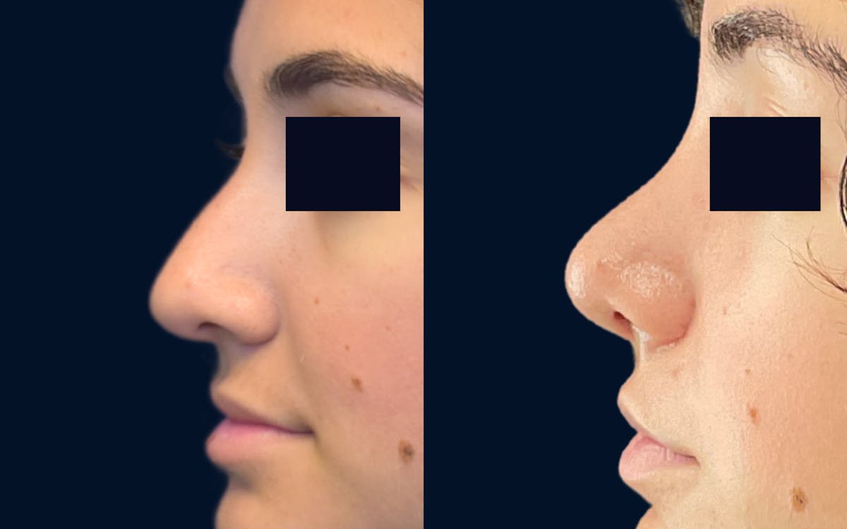 Rhinoplasty Before & After Gallery - Patient 193047 - Image 1