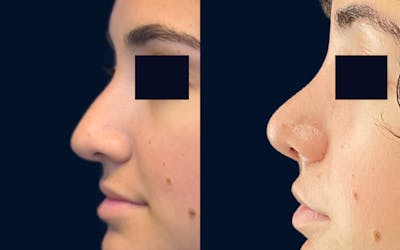 Rhinoplasty Before & After Gallery - Patient 193047 - Image 1