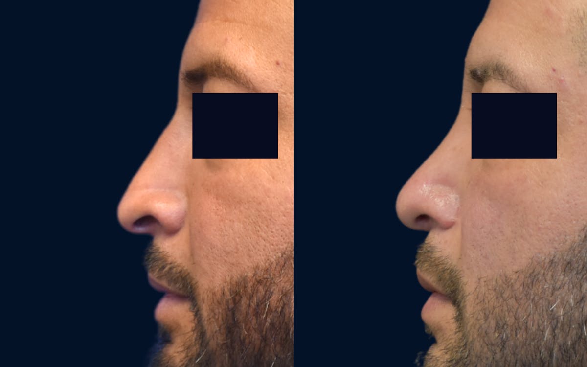 Rhinoplasty Before & After Gallery - Patient 266788 - Image 1