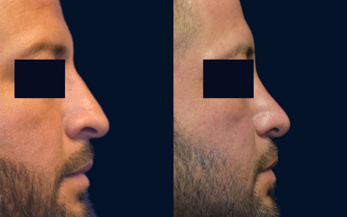 Rhinoplasty Before & After Gallery - Patient 266788 - Image 2