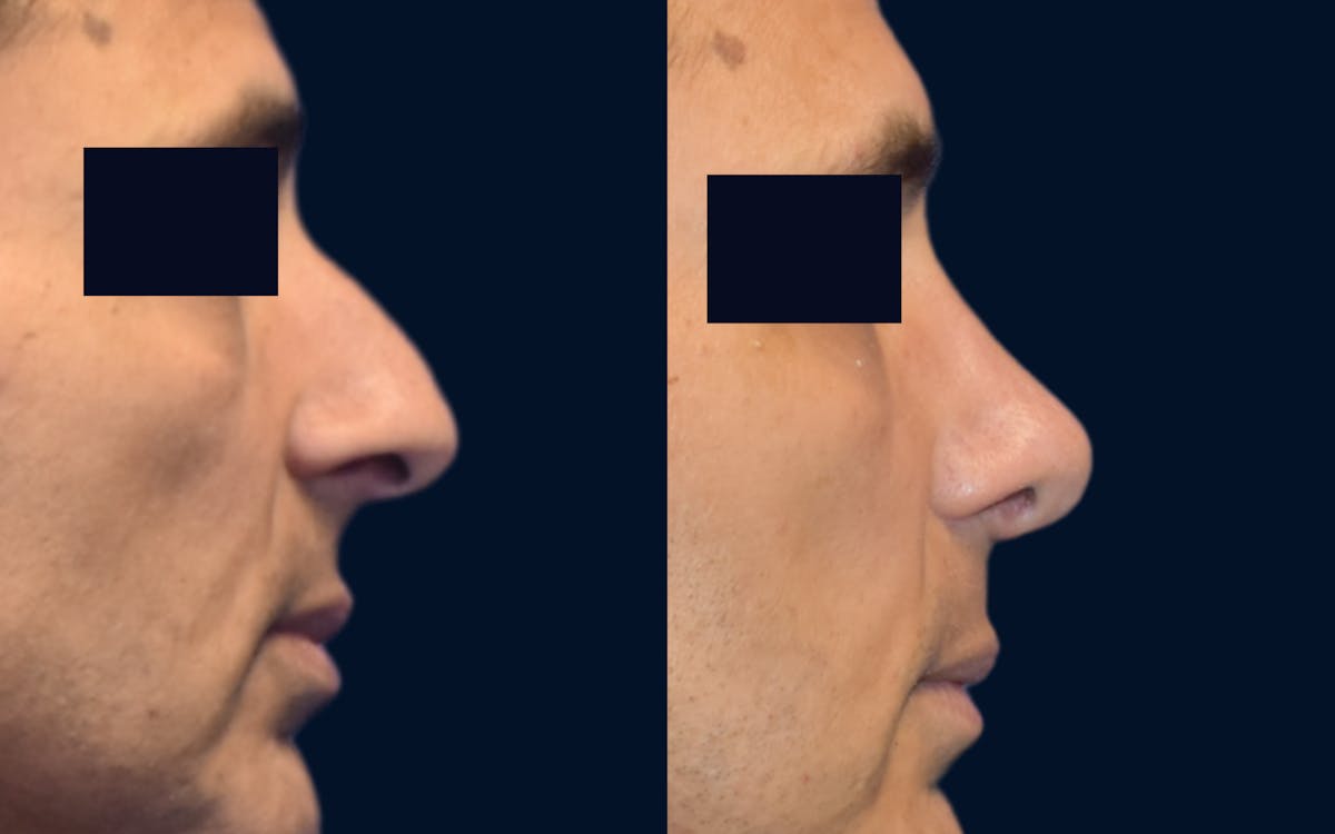 Rhinoplasty Before & After Gallery - Patient 196351 - Image 2