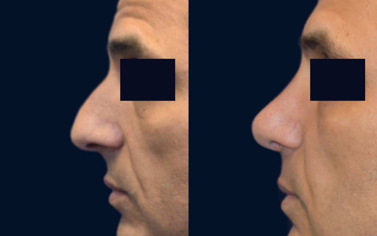 Rhinoplasty Before & After Gallery - Patient 196351 - Image 1
