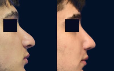 Rhinoplasty Before & After Gallery - Patient 308645 - Image 1