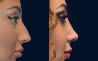 Rhinoplasty Before & After Gallery - Patient 424084 - Image 1
