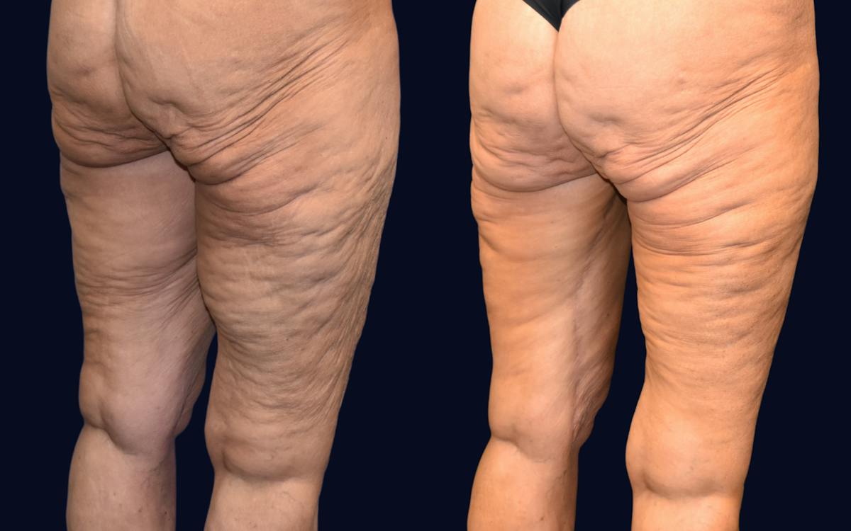 Thigh Lift Before & After Gallery - Patient 217820 - Image 3