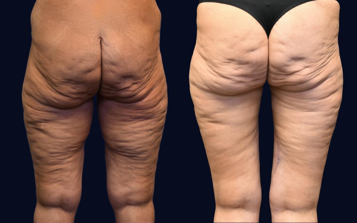 Thigh Lift Before & After Gallery - Patient 217820 - Image 1
