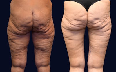 Thigh Lift Before & After Gallery - Patient 217820 - Image 1