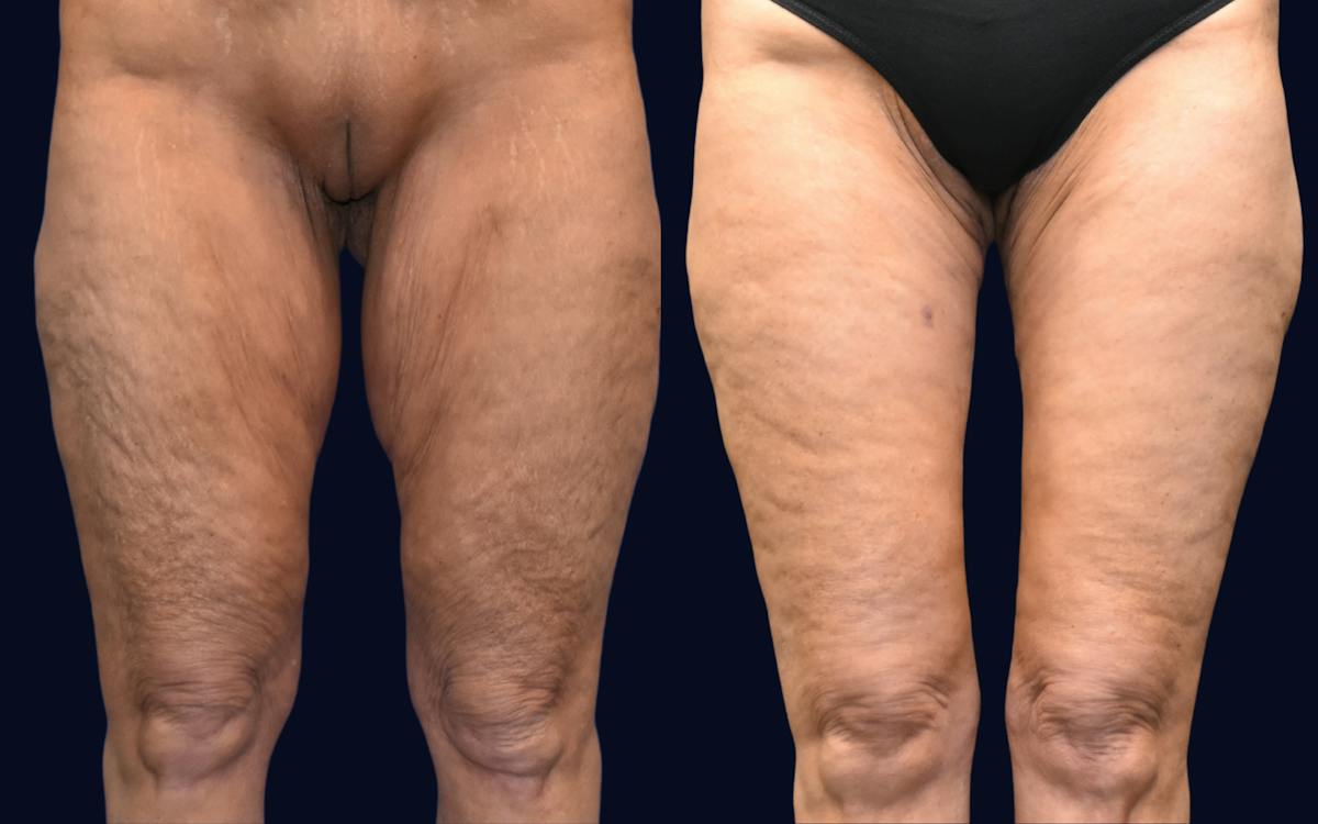 Thigh Lift Before & After Gallery - Patient 217820 - Image 2