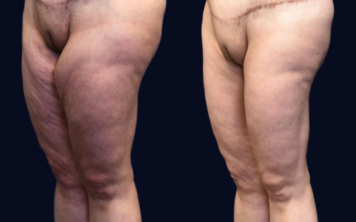 Thigh Lift Before & After Gallery - Patient 102370 - Image 3