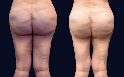 Thigh Lift Before & After Gallery - Patient 102370 - Image 1
