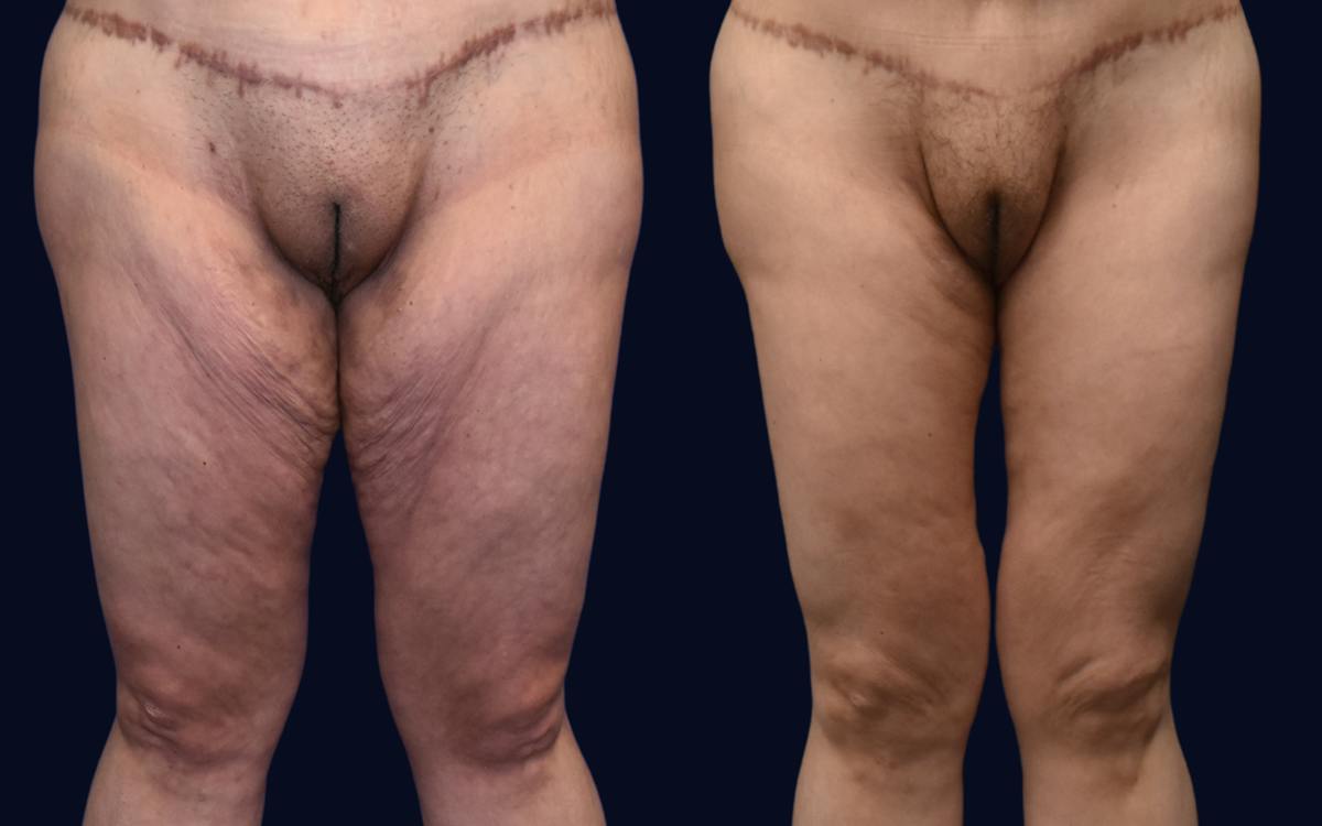 Thigh Lift Before & After Gallery - Patient 102370 - Image 2