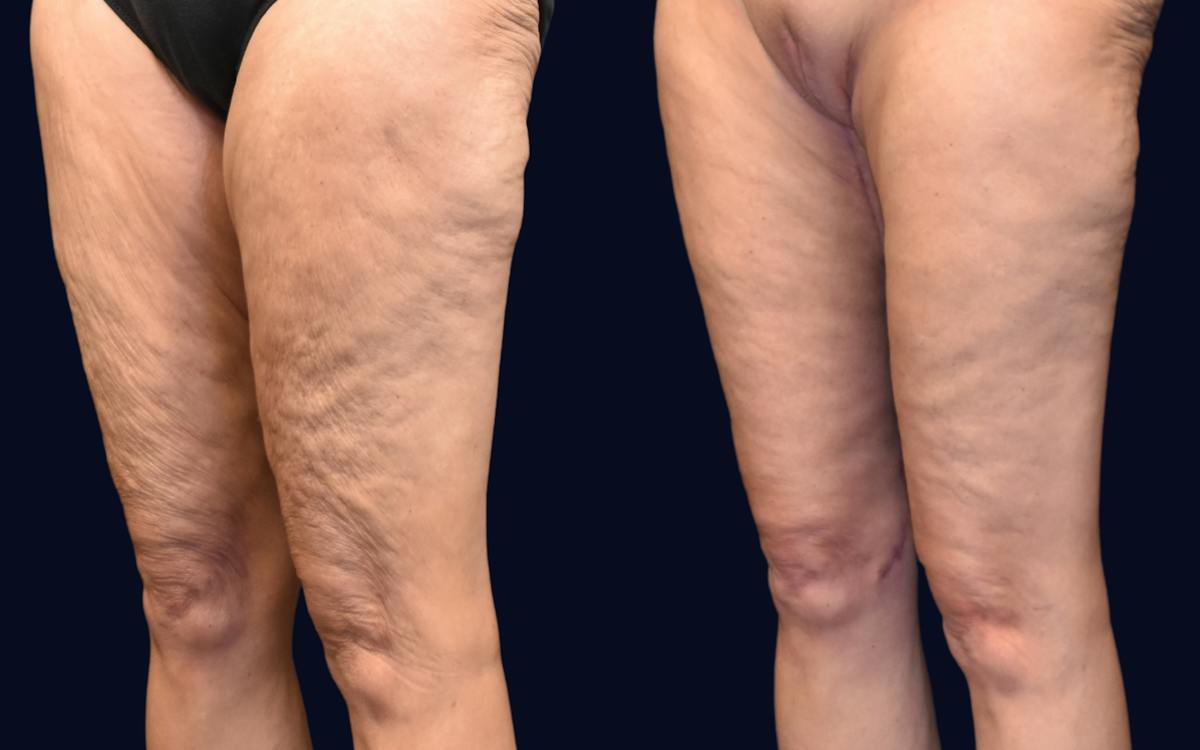 Thigh Lift Before & After Gallery - Patient 105459 - Image 3