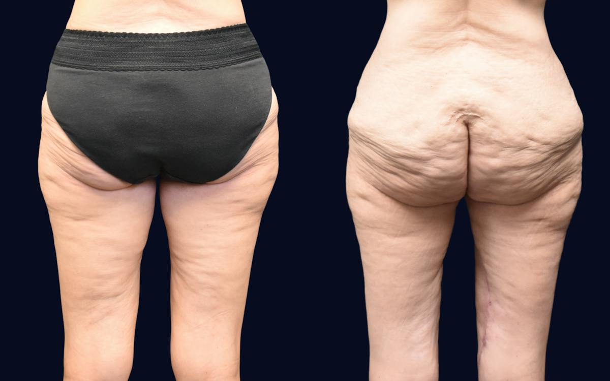 Thigh Lift Before & After Gallery - Patient 105459 - Image 2