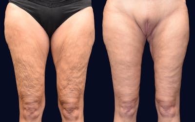 Thigh Lift Before & After Gallery - Patient 105459 - Image 1