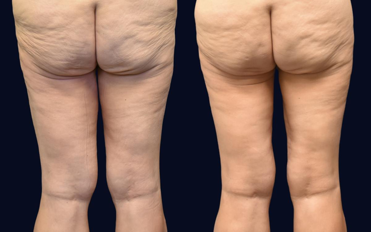 Thigh Lift Before & After Gallery - Patient 390219 - Image 1