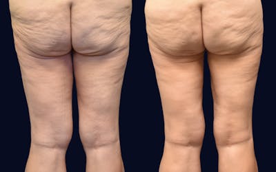 Thigh Lift Before & After Gallery - Patient 390219 - Image 1